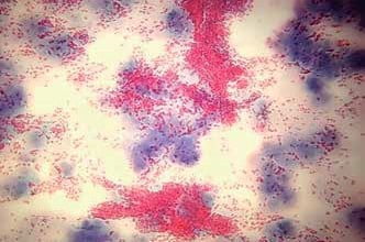 Figura 1. Células epiteliales dispuestas en mantos sólidos asociados a un estroma metacromático (Papanicolau 4x).